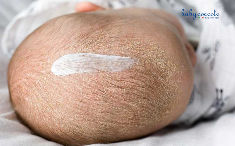 cứt trâu ở trẻ