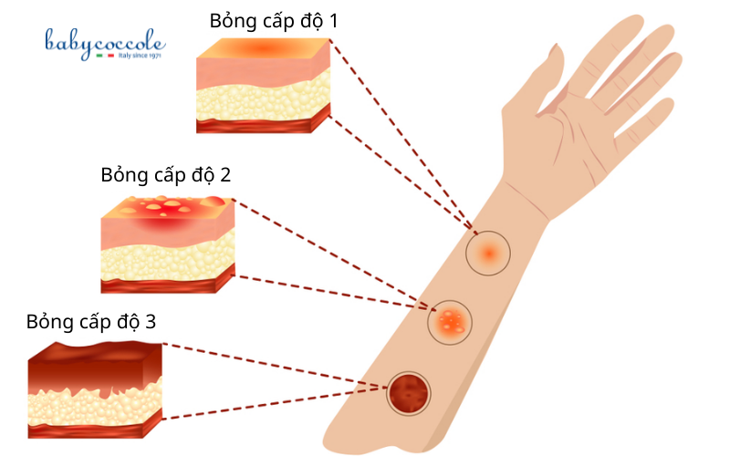 xử lý khi trẻ bị bỏng